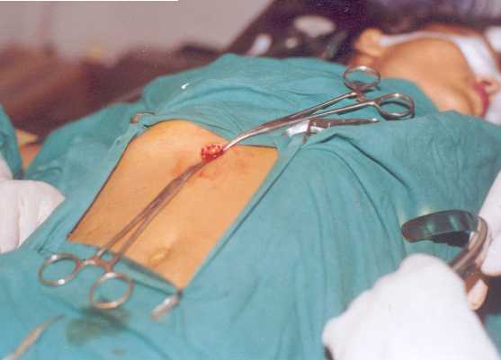 Gall Bladder Incision